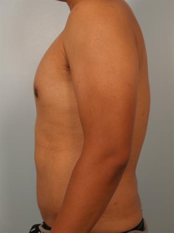 Male Liposuction Before & After Gallery - Patient 1310880 - Image 2