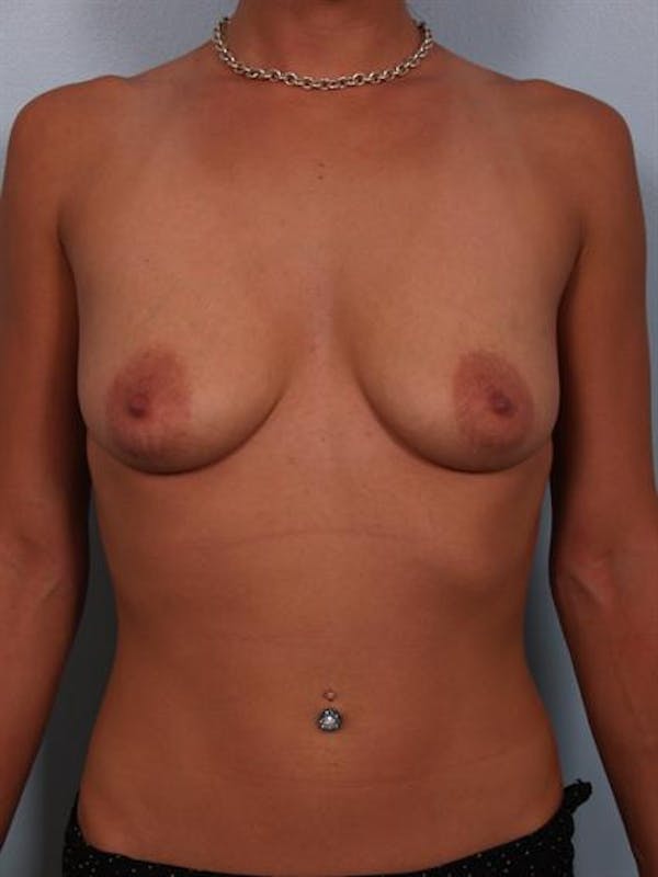 Breast Lift Before & After Gallery - Patient 1310881 - Image 1