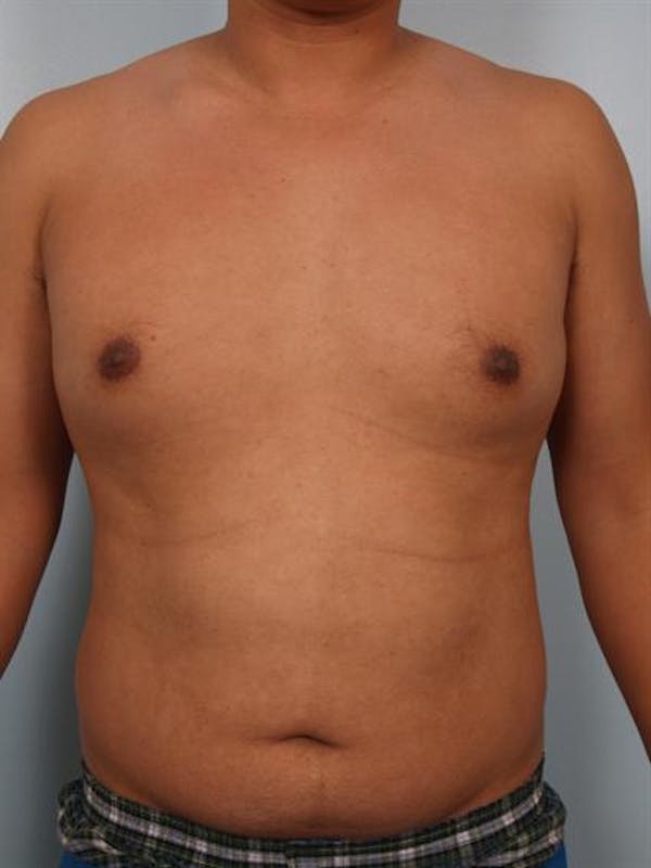 Male Liposuction Before & After Gallery - Patient 1310880 - Image 3