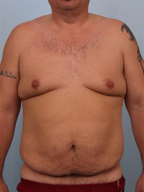 Tummy Tuck Before & After Gallery - Patient 1310883 - Image 1