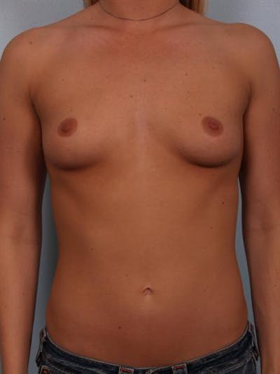 Breast Augmentation Before & After Gallery - Patient 1310885 - Image 1