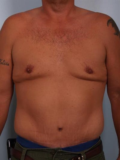 Tummy Tuck Before & After Gallery - Patient 1310883 - Image 2