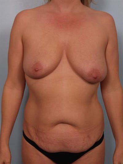Mommy Makeover Before & After Gallery - Patient 1310882 - Image 1