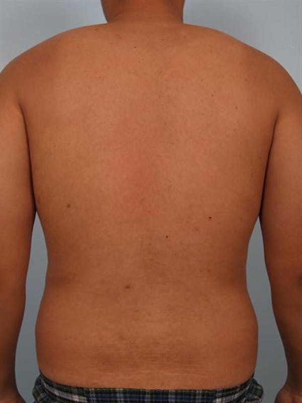 Male Liposuction Gallery - Patient 1310880 - Image 5