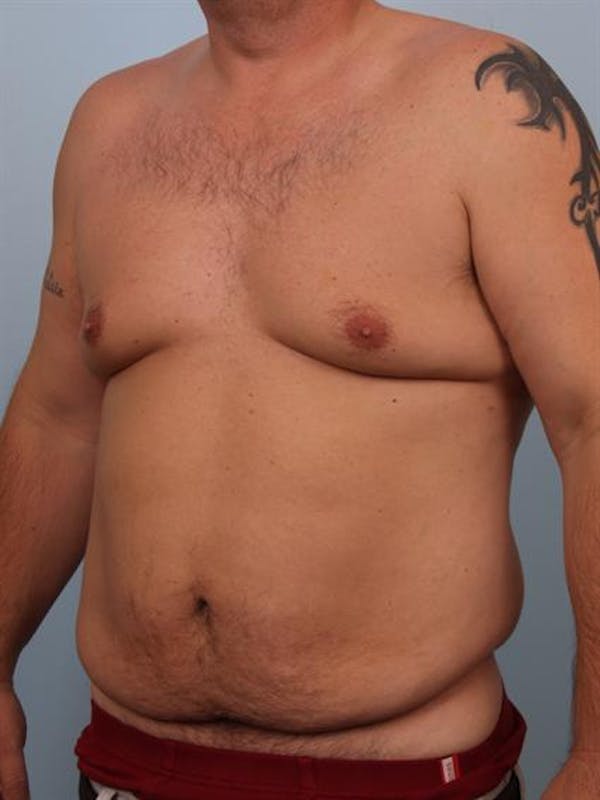 Tummy Tuck Before & After Gallery - Patient 1310883 - Image 3