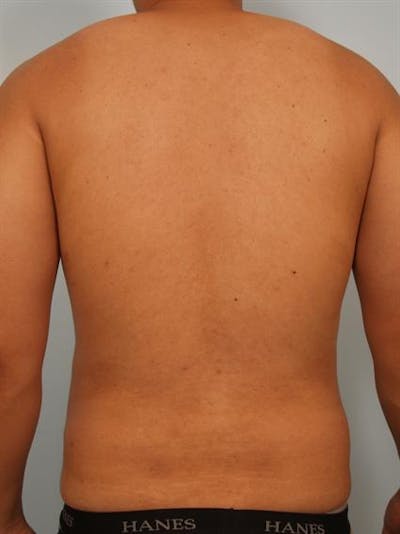 Male Liposuction Before & After Gallery - Patient 1310880 - Image 6