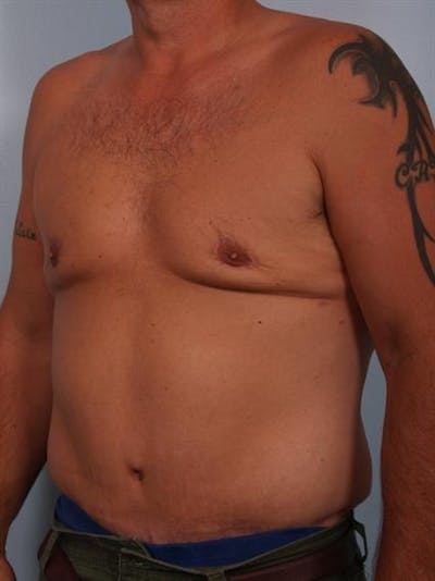 Tummy Tuck Before & After Gallery - Patient 1310883 - Image 4