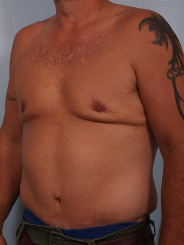 Tummy Tuck Before & After Gallery - Patient 1310883 - Image 4