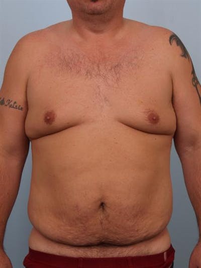 Male Liposuction Before & After Gallery - Patient 1310886 - Image 1