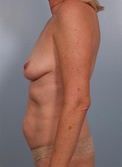 Tummy Tuck Before & After Gallery - Patient 1310888 - Image 1