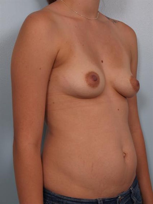 Breast Lift Before & After Gallery - Patient 1310889 - Image 3