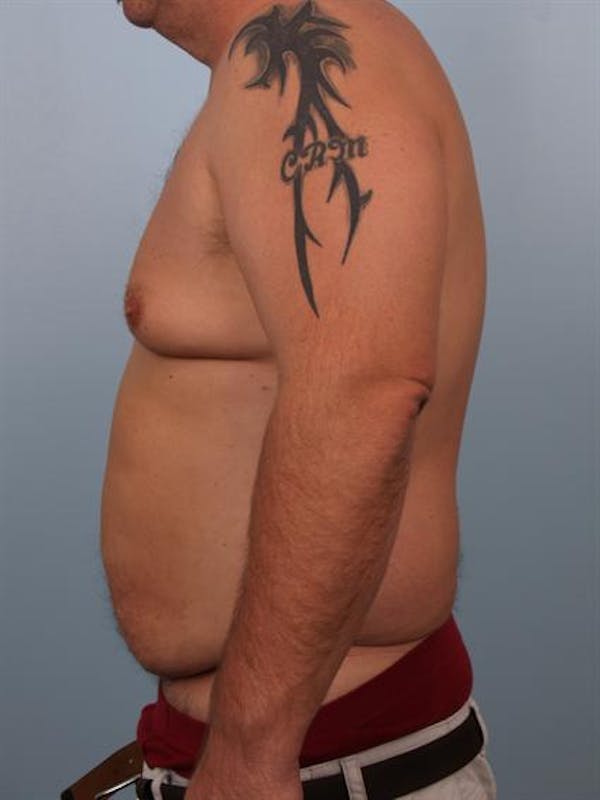 Male Liposuction Before & After Gallery - Patient 1310886 - Image 5