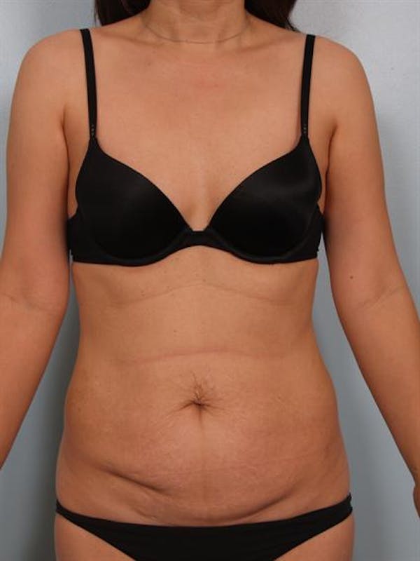 Power Assisted Liposuction Before & After Gallery - Patient 1310890 - Image 1