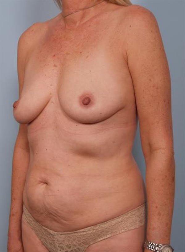 Tummy Tuck Before & After Gallery - Patient 1310888 - Image 3