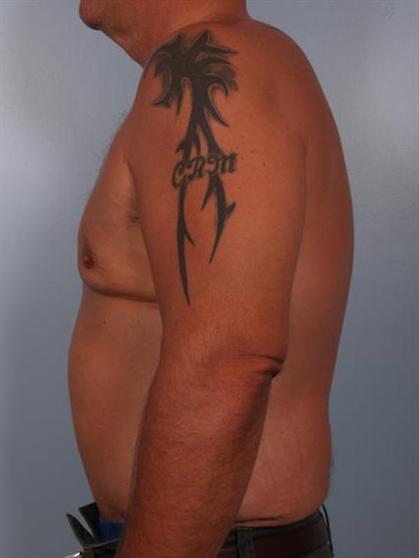 Male Liposuction Before & After Gallery - Patient 1310886 - Image 6