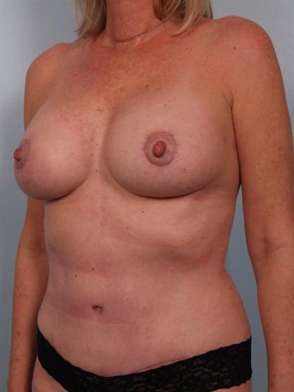 Tummy Tuck Before & After Gallery - Patient 1310888 - Image 4