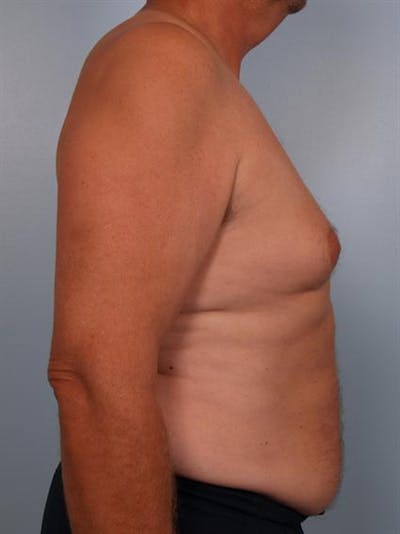 Male Liposuction Before & After Gallery - Patient 1310893 - Image 1