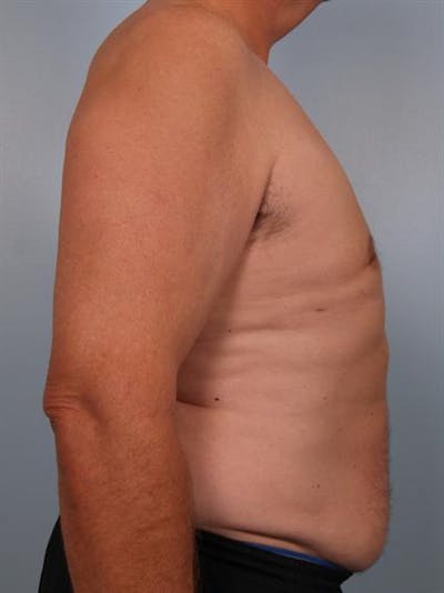Male Liposuction Before & After Gallery - Patient 1310893 - Image 2