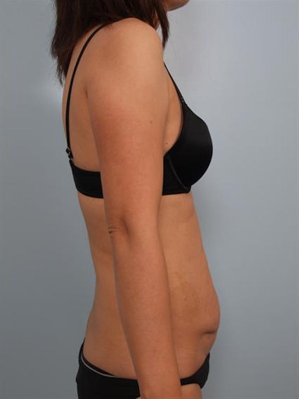 Power Assisted Liposuction Before & After Gallery - Patient 1310890 - Image 5