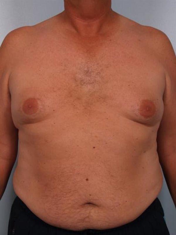 Male Liposuction Before & After Gallery - Patient 1310893 - Image 3