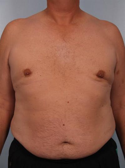 Male Liposuction Before & After Gallery - Patient 1310893 - Image 4