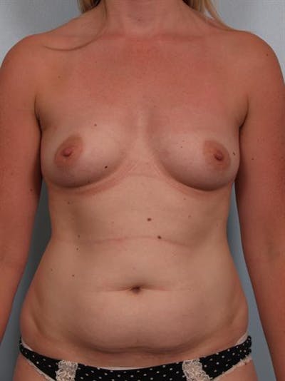 Tummy Tuck Before & After Gallery - Patient 1310896 - Image 1