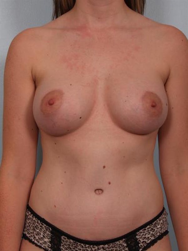 Tummy Tuck Before & After Gallery - Patient 1310896 - Image 2