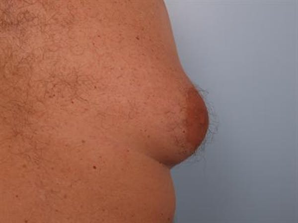 Male Liposuction Before & After Gallery - Patient 1310893 - Image 5
