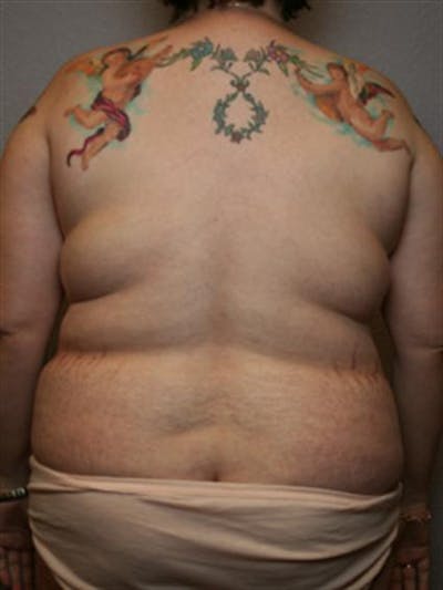 Power Assisted Liposuction Before & After Gallery - Patient 1310895 - Image 1
