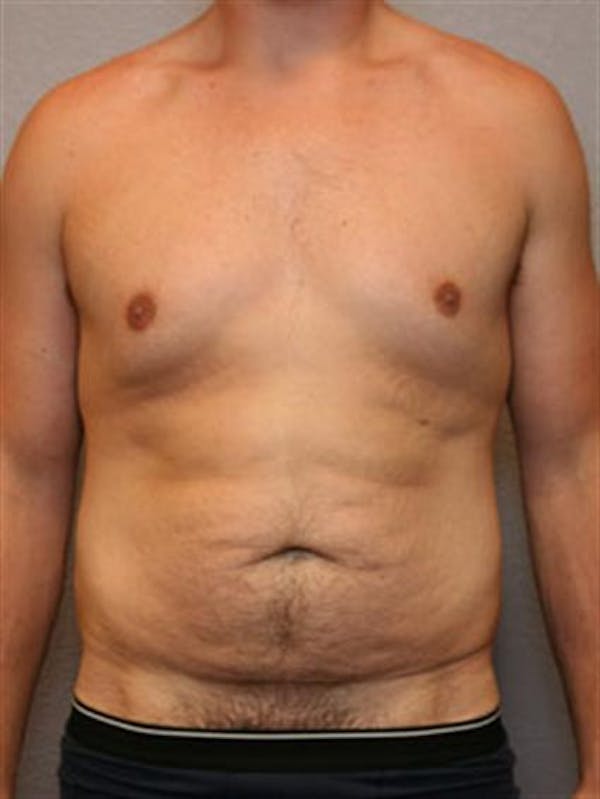 Male Tummy Tuck Before & After Gallery - Patient 1310898 - Image 1