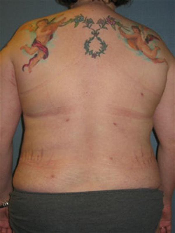 Power Assisted Liposuction Before & After Gallery - Patient 1310895 - Image 2