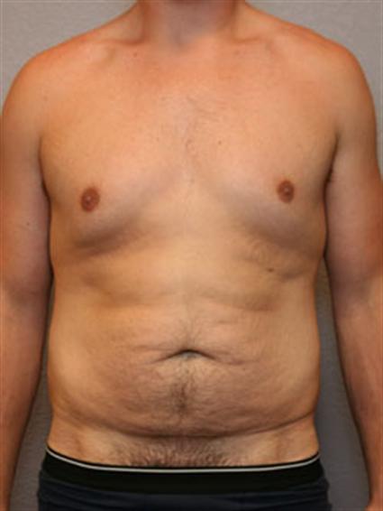 Gynecomastia Before Photo Patient 4