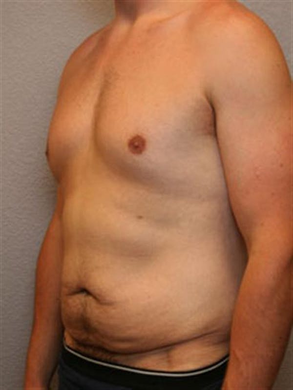 Male Tummy Tuck Before & After Gallery - Patient 1310898 - Image 3