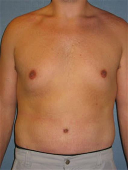 Gynecomastia After Photo Patient 4