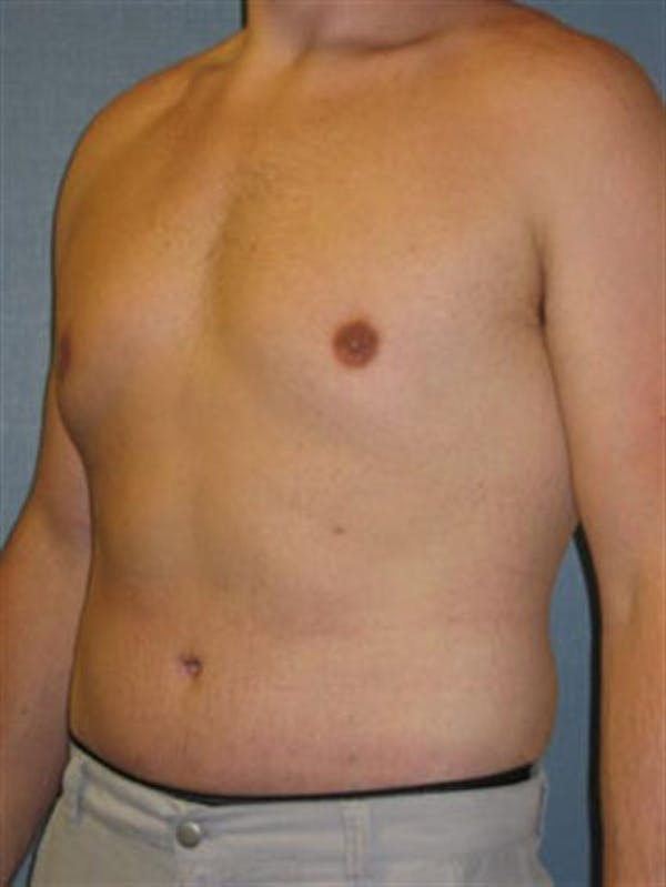 Male Tummy Tuck Before & After Gallery - Patient 1310898 - Image 4