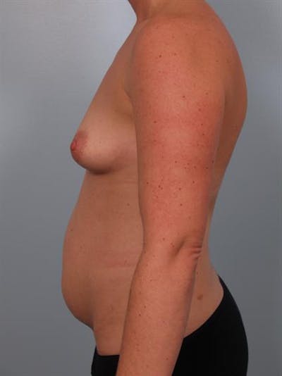 Power Assisted Liposuction Before & After Gallery - Patient 1310901 - Image 1