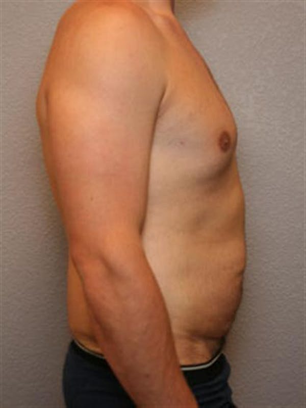 Male Tummy Tuck Before & After Gallery - Patient 1310898 - Image 5