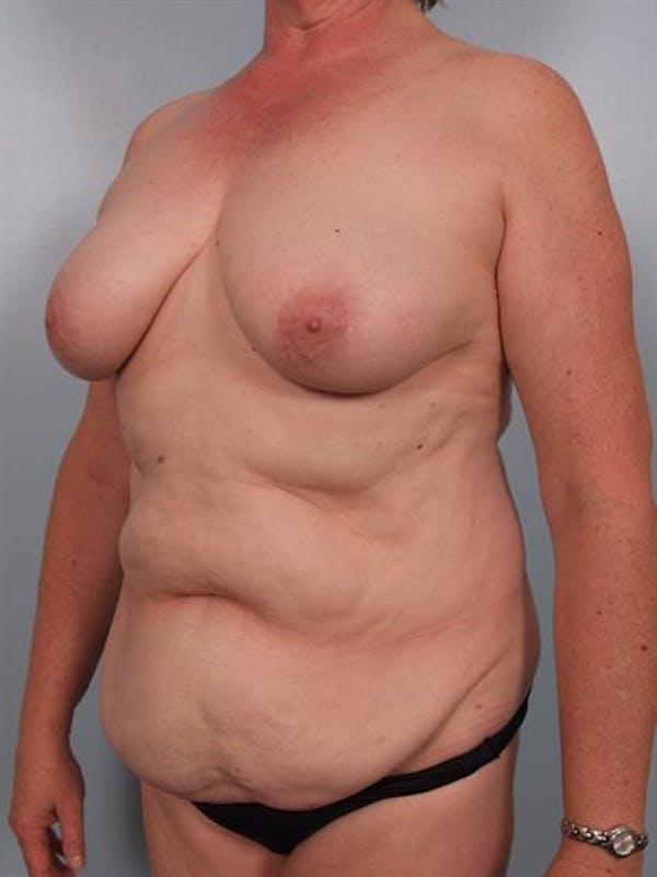 Tummy Tuck Before & After Gallery - Patient 1310902 - Image 1