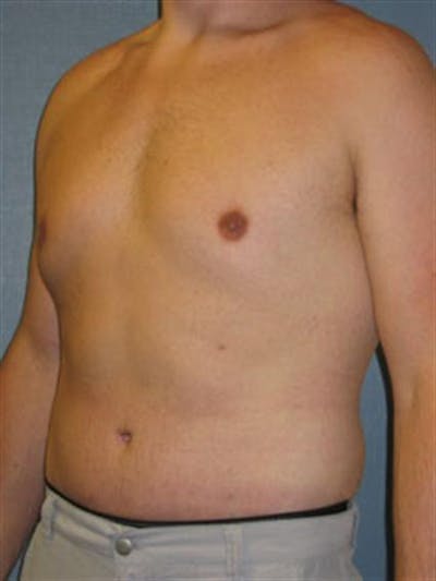 Male Liposuction Before & After Gallery - Patient 1310900 - Image 4