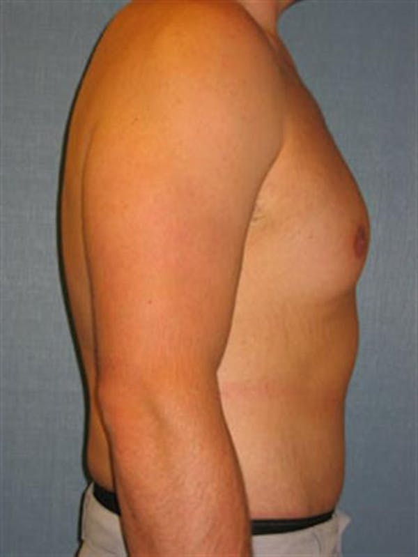 Male Tummy Tuck Before & After Gallery - Patient 1310898 - Image 6