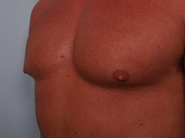 Male Breast/Areola Reduction Gallery - Patient 1310907 - Image 1