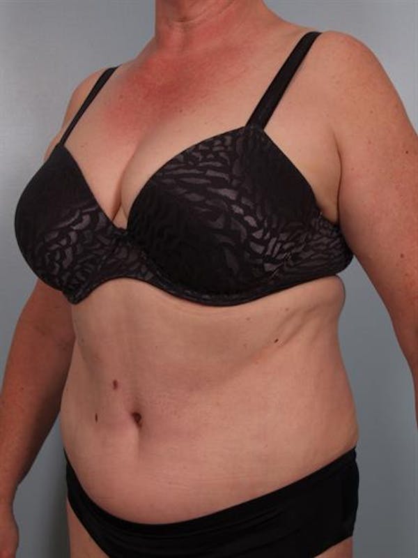 Tummy Tuck Before & After Gallery - Patient 1310902 - Image 2
