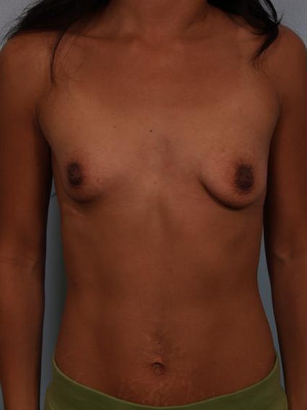 Breast Lift Gallery - Patient 1310905 - Image 1