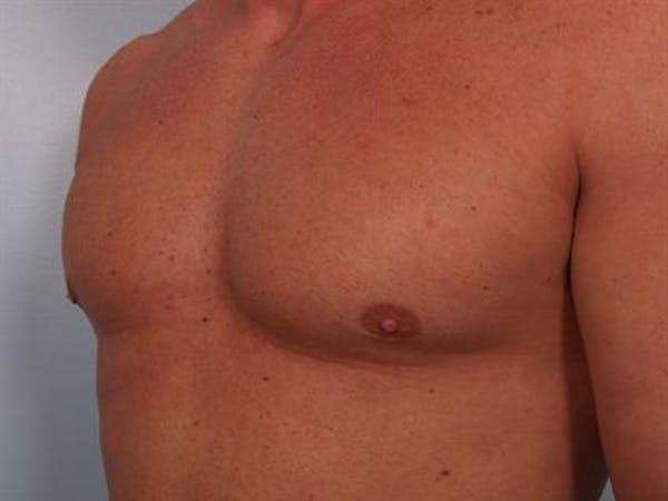 Male Breast/Areola Reduction Before & After Gallery - Patient 1310907 - Image 2