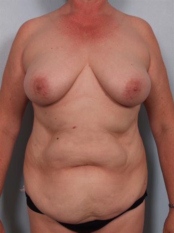 Tummy Tuck Before & After Gallery - Patient 1310902 - Image 3
