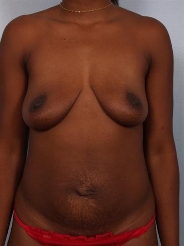 Breast Augmentation Before & After Gallery - Patient 1310903 - Image 3