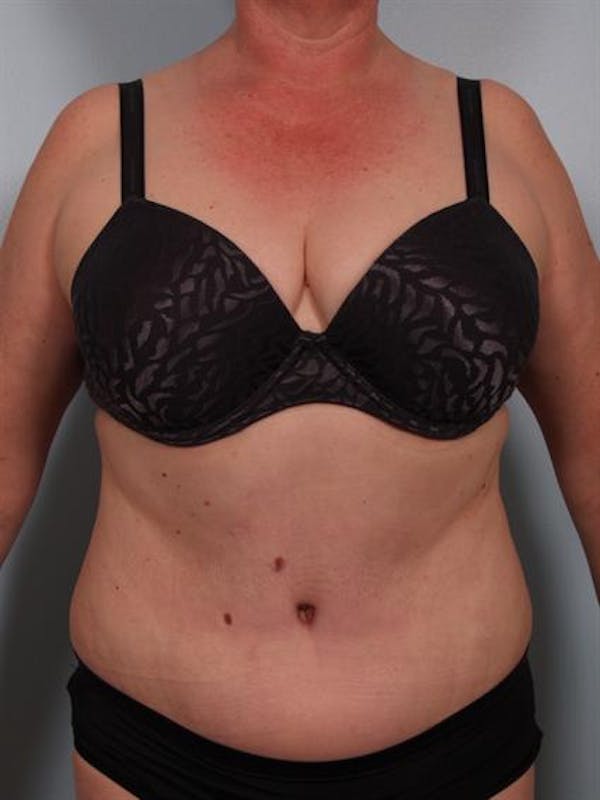 Tummy Tuck Gallery - Patient 1310902 - Image 4