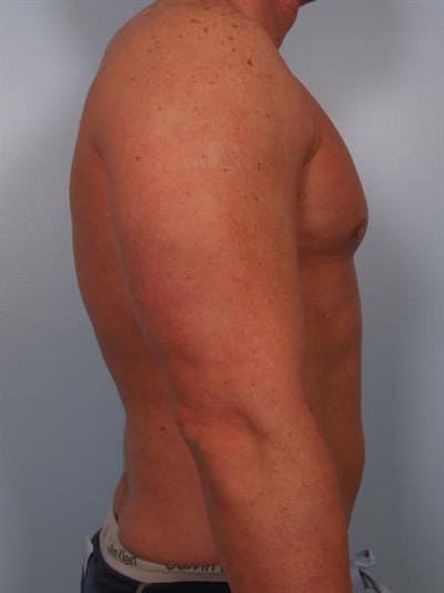 Male Breast/Areola Reduction Gallery - Patient 1310907 - Image 4