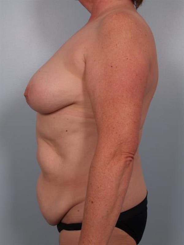 Tummy Tuck Before & After Gallery - Patient 1310902 - Image 5