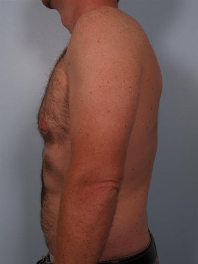 Male Liposuction Before & After Gallery - Patient 1310910 - Image 1
